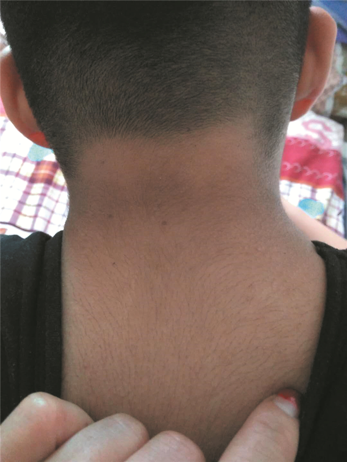 一例ihh合并严重胰岛素抵抗患者颈部的黑棘皮样改变