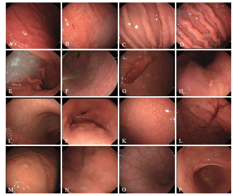京都胃炎分类在白光胃镜下直接判断幽门螺杆菌感染中
